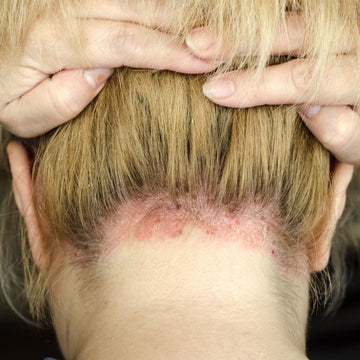 Can PropoRelief™ Scalp Shampoo & Conditioner Help With Psoriasis?